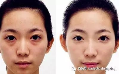 眼袋怎么变卧蚕整形图片,外切眼袋保留卧蚕怎么没有卧蚕呢