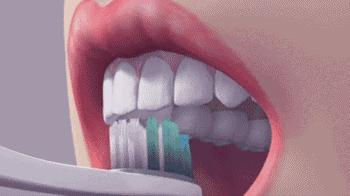 10岁儿童蛀牙怎么治疗最好,如何预防孩子蛀牙龋齿