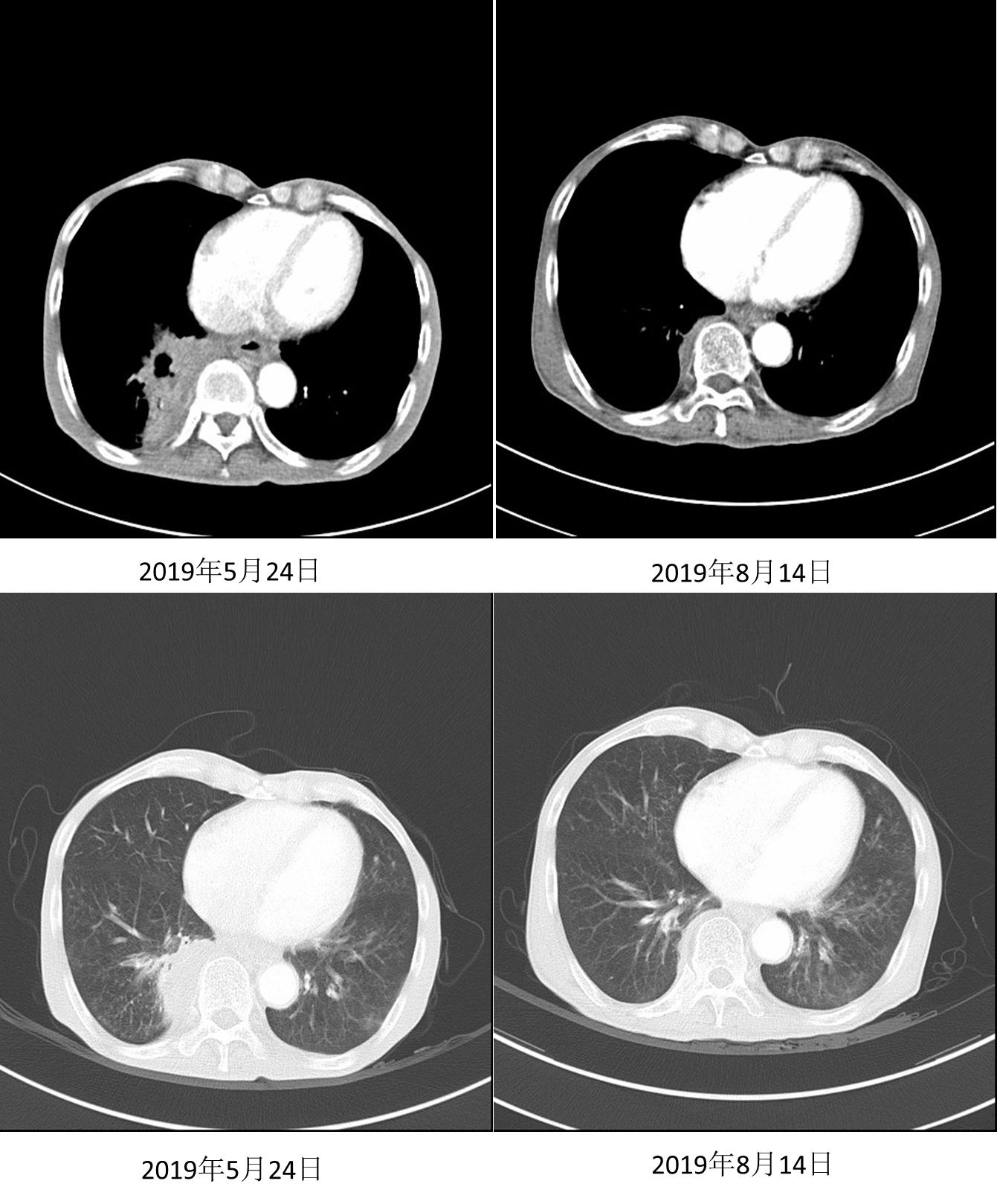 信迪利单抗治疗肺鳞癌效果,信迪利单抗治疗肺鳞癌晚期