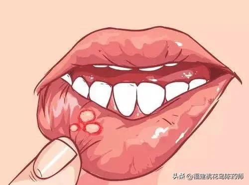 复发性口腔溃疡的原因及治疗方法,顽固性口腔溃疡有什么好药