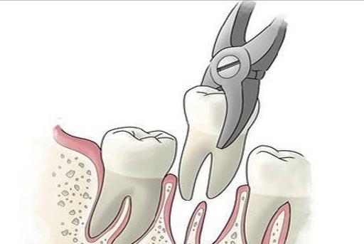 牙齿拔了之后发炎是什么样子,牙齿拔掉后内部神经会怎样