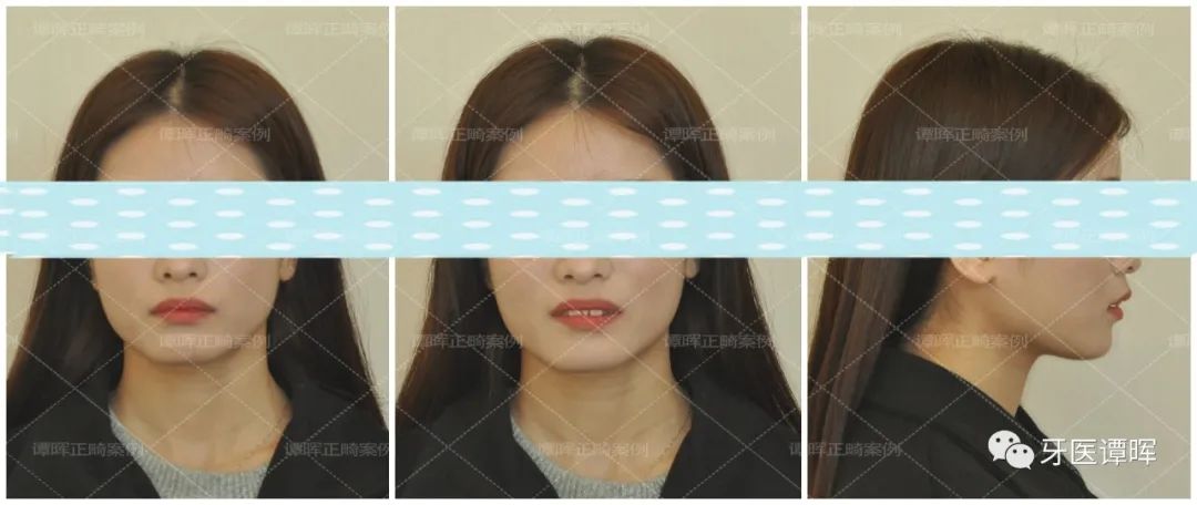 门牙前突牙齿不齐矫正案例分享,门牙和旁边牙齿不齐最快矫正方法