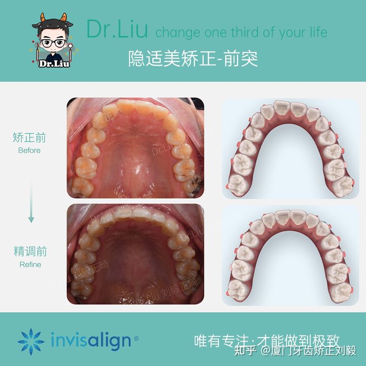 牙齿矫正厦门口腔医院,厦门隐形龅牙矫正优惠