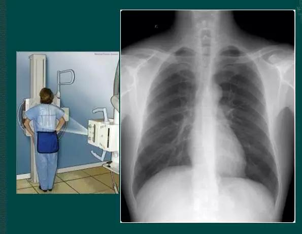 拿到胸片却不会看？送你7个窍门，手把手教你解读胸片（收藏）