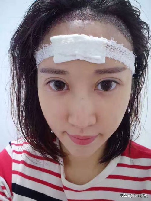 植发后多久可以看到效果,植发后多久能看到效果