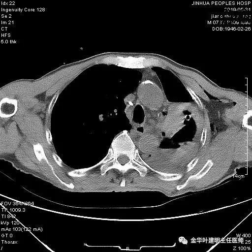 手术引起乳糜胸,有没有做了肺结节手术后是误诊的