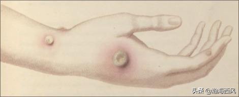 最早发明疫苗的科学家,世界上最早的牛痘接种方法