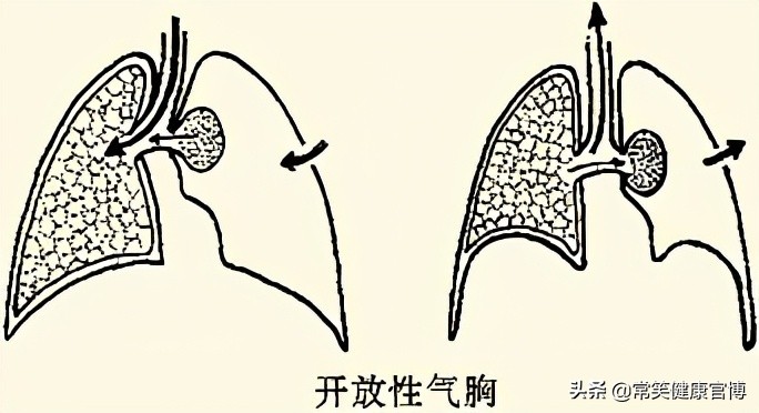 气胸复发隐约有点疼呼吸不受影响,气胸是什么原因造成的呢图文介绍