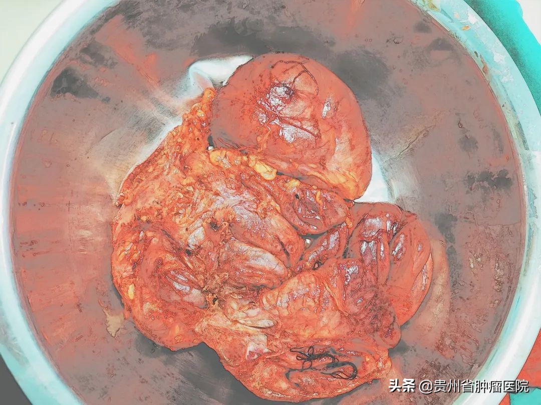 老人屁股肿块迅速长大是什么原因,老人臀部内硬块