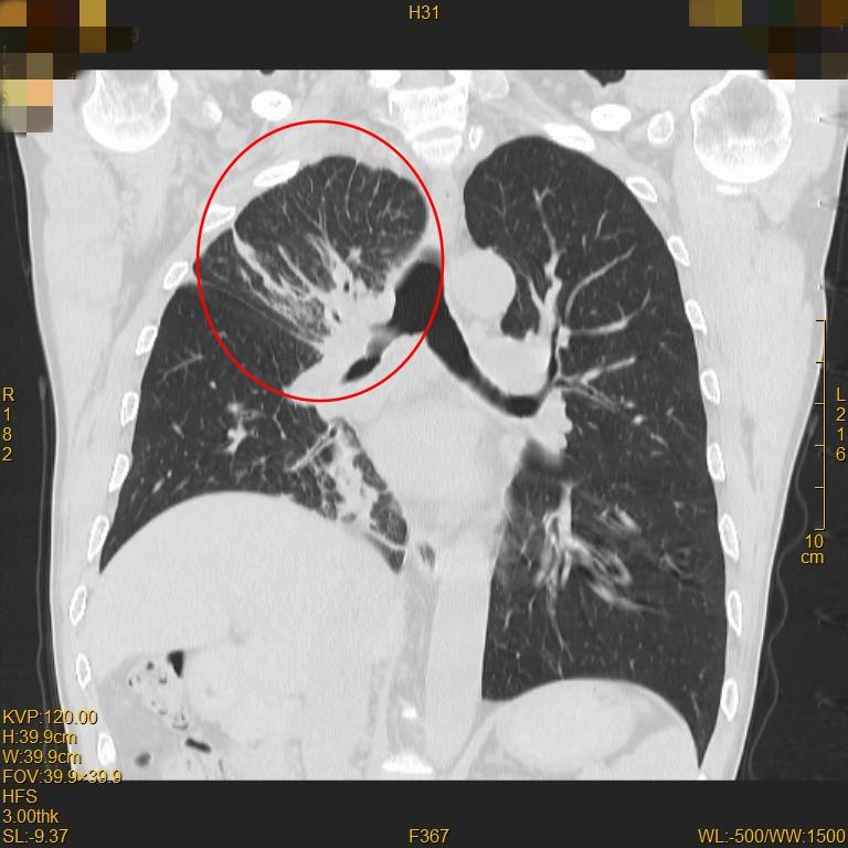 一束光杀灭癌细胞设备,一束光治疗癌症全国几家医院有
