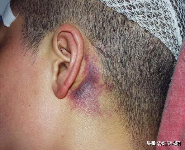 颅脑外伤治疗指南,颅脑损伤康复科普知识汇总