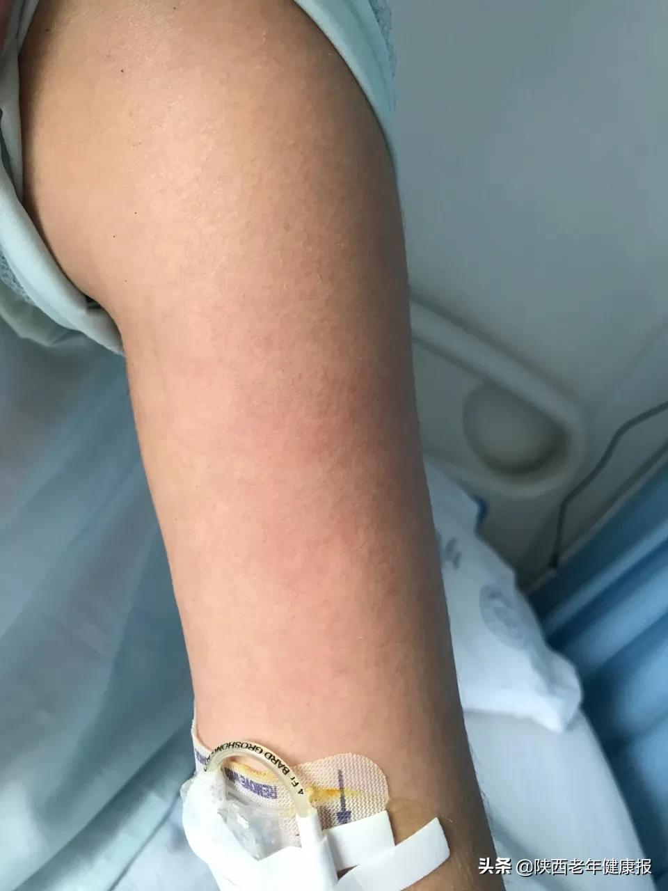 picc置管术操作过程演示,医德精湛的医术为患者解忧