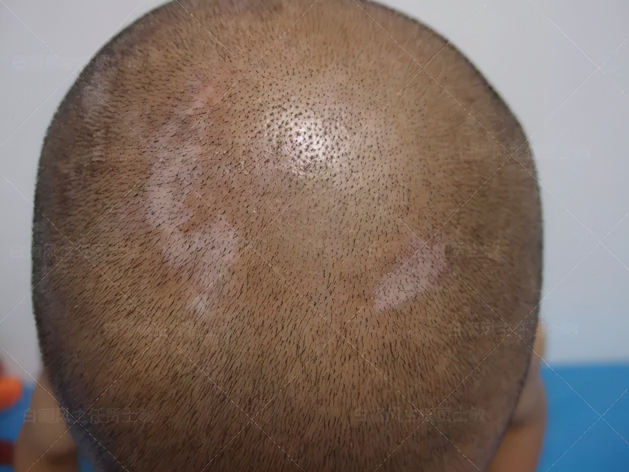 好多人说白癜风治不好,手指上白癜风治好的案例