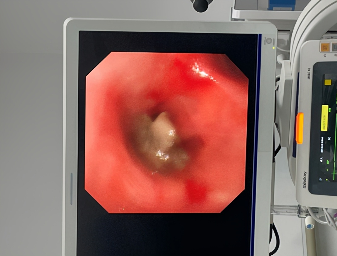 女子莫名咳嗽两年多结石竟长在支气管上哈医大一院群力院区多学科协作开展全麻下电子支气管镜取石