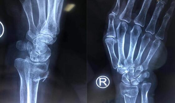85岁老太摔倒被扶,八旬老太摔骨折