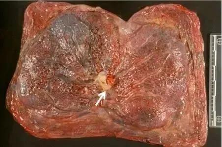 临床上最常见的异常胎盘,前置胎盘和低置胎盘超声