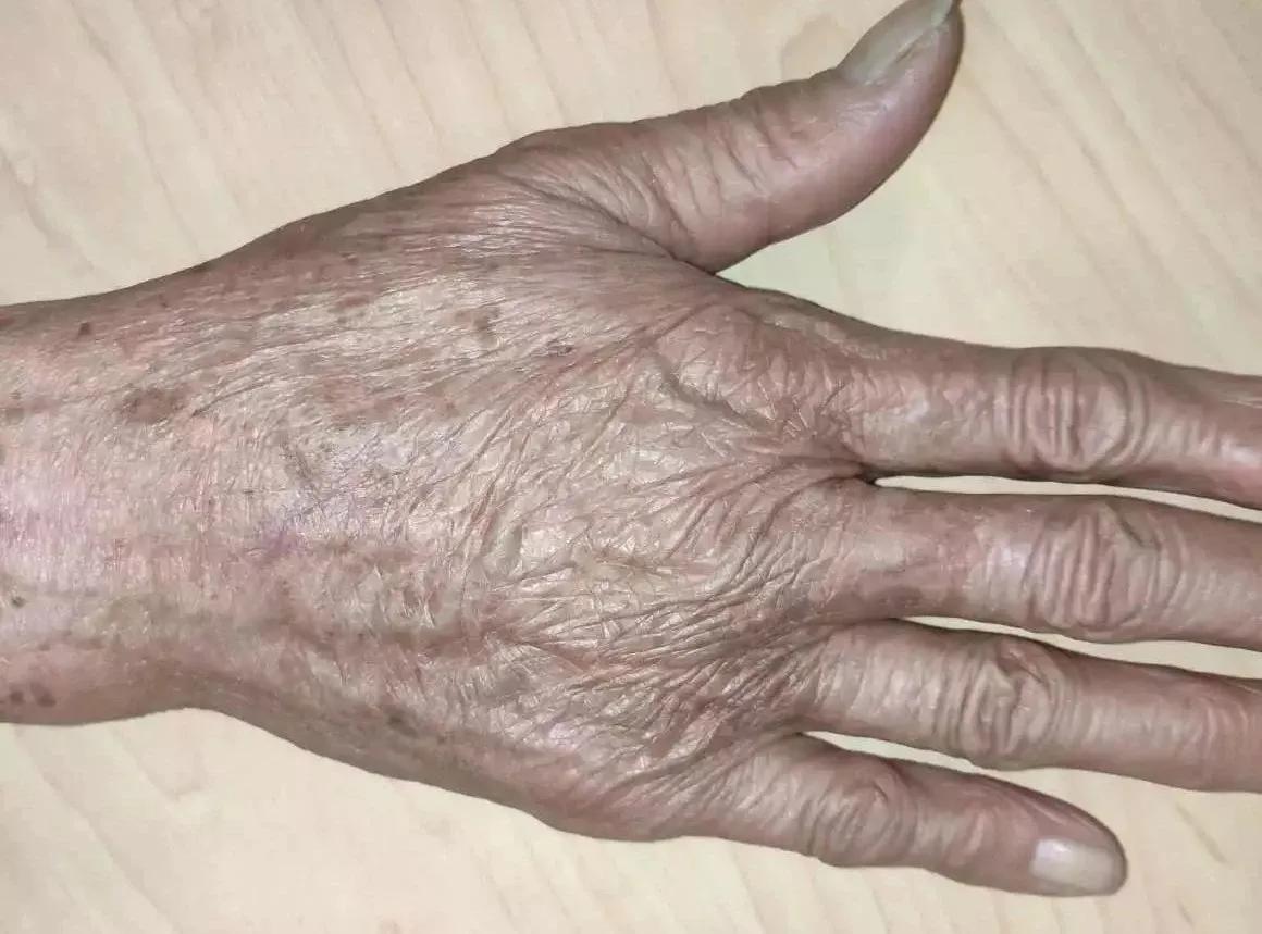 挤痘痘引发脑膜炎几率,挤痘痘会引发囊肿吗