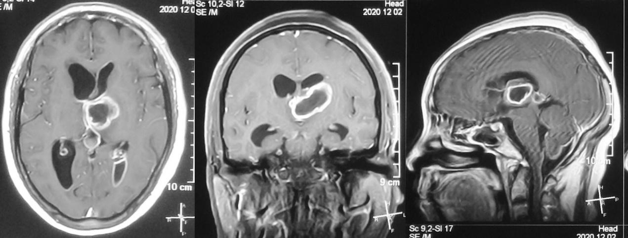 脑脓肿合并脑膜炎需要手术吗,脑脓肿进入左侧脑室严重吗