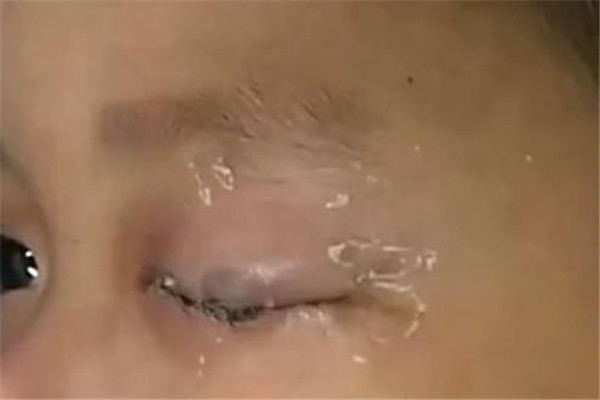 宝宝误拿502胶水滴眼睛怎么办,宝宝误将502滴到眼睛怎么办