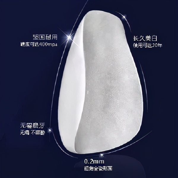 牙齿贴面能修复牙缝大的问题吗,齿科全瓷贴面美白