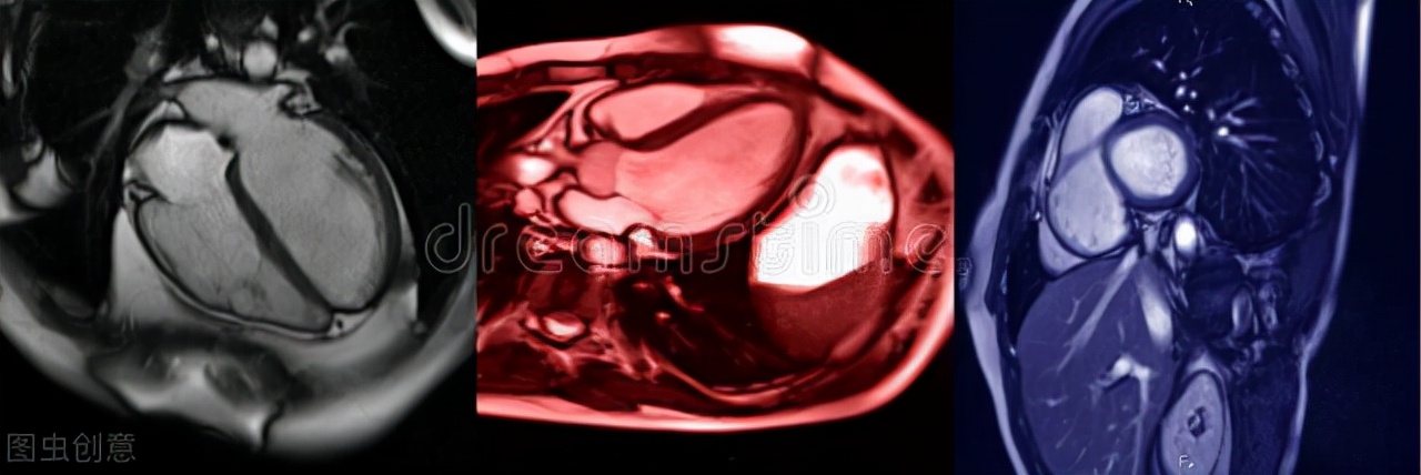 中年男士胸闷做什么ct,胸闷胸痛查冠脉造影