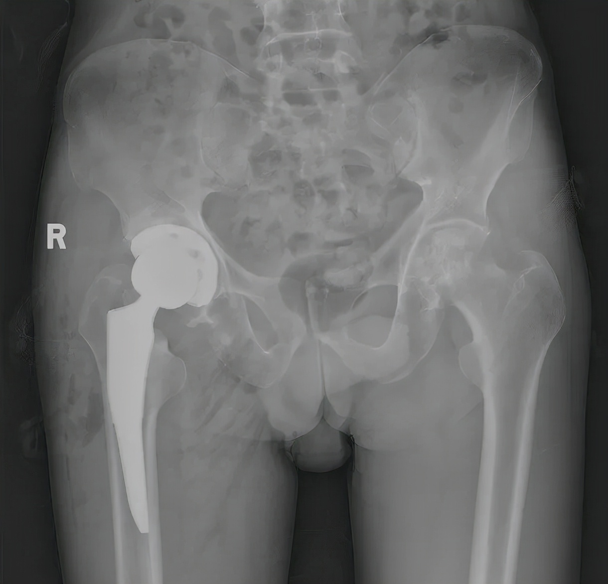 间歇性跛行一年了一直能走五百米,间歇性跛行一年了能恢复吗