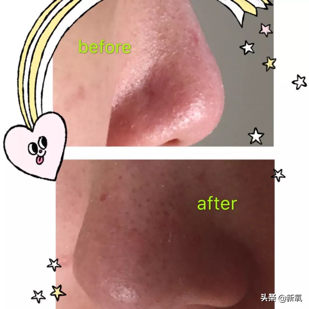 去黑头最有效的方法一个月见效,别挤了教你去黑头的正确方法