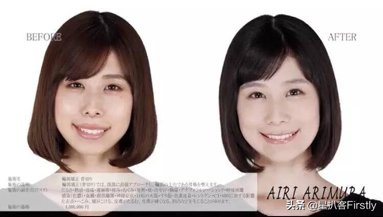 下颌骨缩小整容,下颌骨切除整容