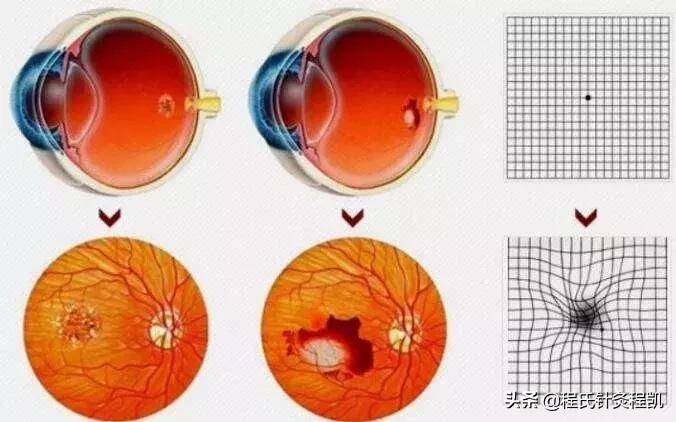 针灸治疗黄斑病变,视网膜黄斑变性的针灸治疗