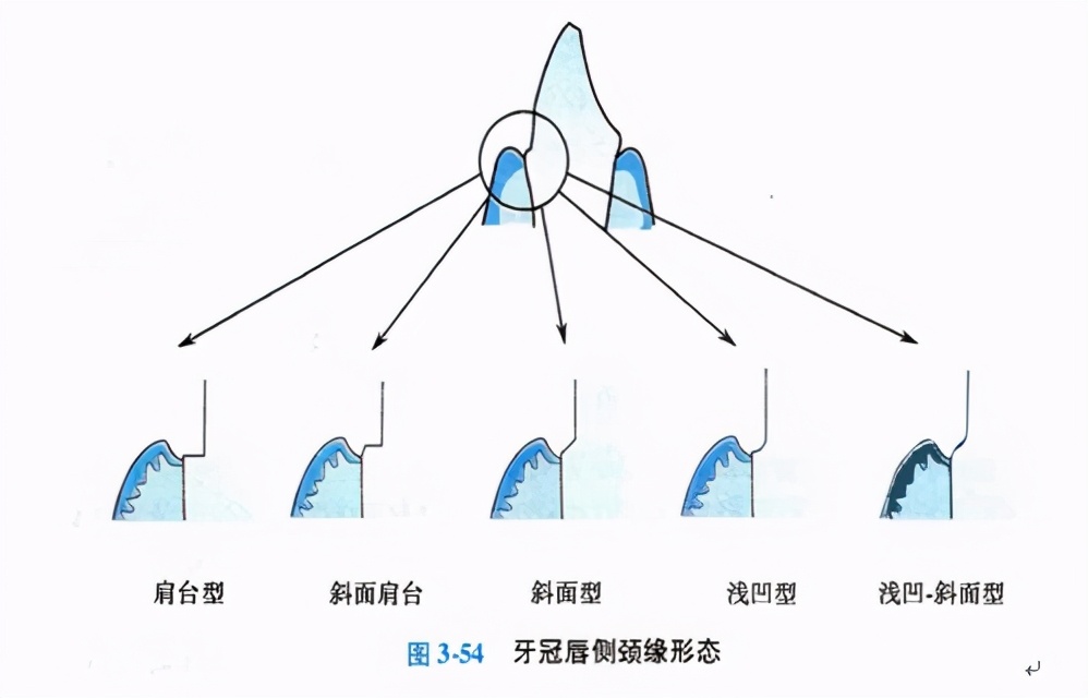 口腔金属冠与全瓷冠的区别,牙科医生讲义