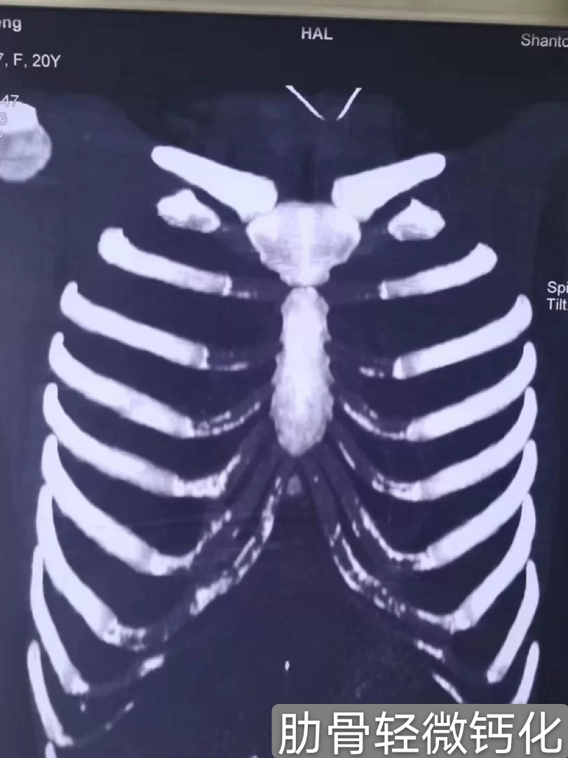 隆鼻怎么知道肋骨有没有钙化,肋骨钙化还能隆鼻吗