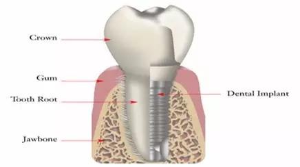 种植牙种植失败可以要求退款吗,种植牙失败了哪里投诉