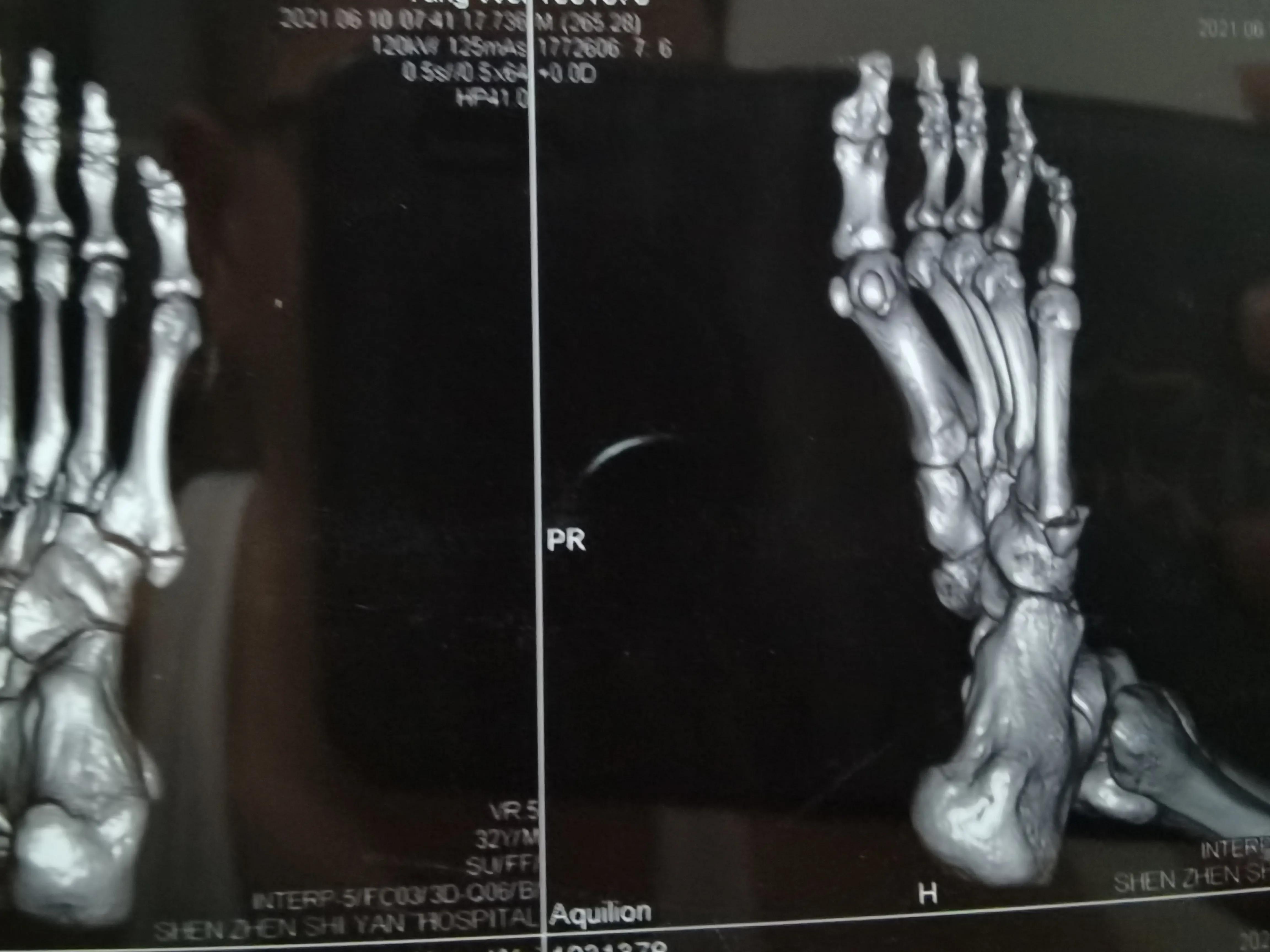 第五跖骨粉碎性骨折多久后能走路,第五跖骨基底骨折100天了走路肿