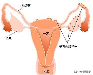 子宫内膜异位症会引起ca125偏高吗,子宫内膜异位症的用药