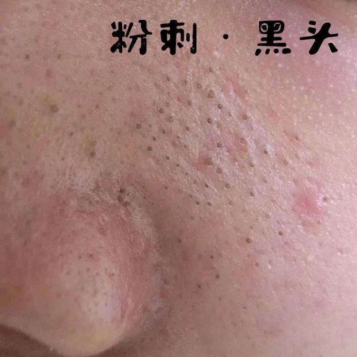 为什么你的痘印总是消不下去,为什么你的祛斑效果不理想