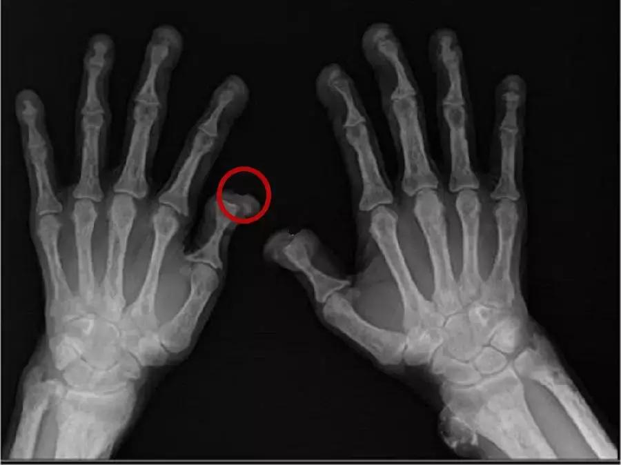 慢性肾病透析后肾还能恢复吗,慢性肾功能衰竭尿毒症透析