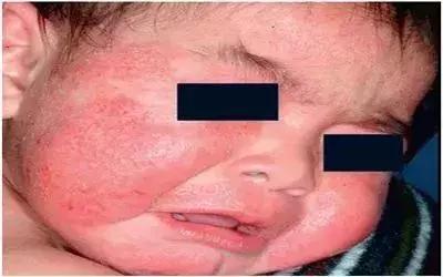 小儿麻疹两天疹子就没有了好不好,小孩荨麻疹最怕三个土方法