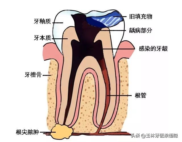 牙齿发炎常规处理？当心延误病情！（值得收藏，推荐）