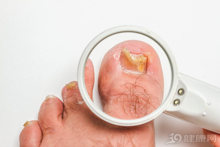 嵌甲旁边长了一小坨肉是怎么回事,脚趾甲老是往肉里长怎么矫正