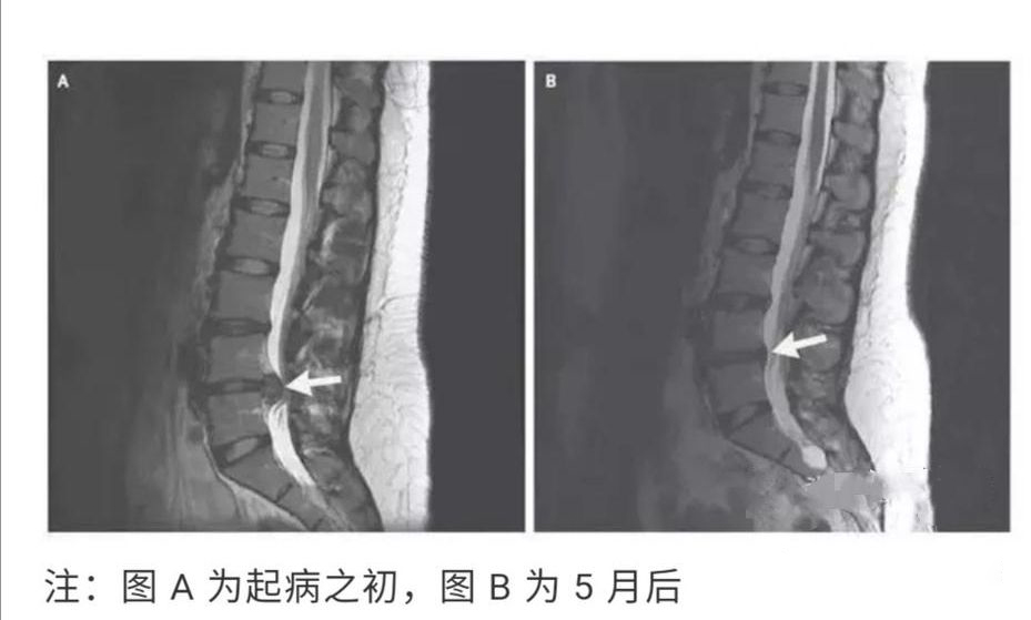 椎间盘突出病案分析,腰椎间盘突出做手术好久恢复正常
