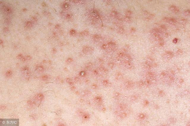 后背毛糙还长痘,后背长痘毛囊炎怎么办