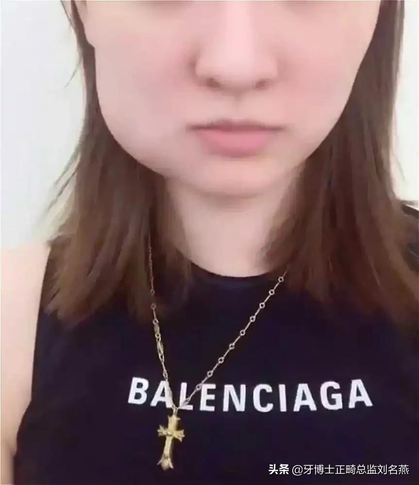 智齿拔除肿成猪头多久恢复,拔了智齿为什么脸肿了