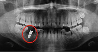 2000块的种植体你真的敢种吗?为什么会这么便宜,良心牙医告诉你