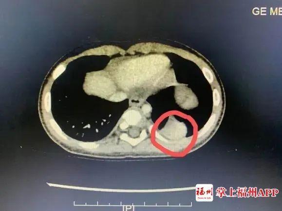 小孩咳嗽发烧已经3天,5个月宝宝咳嗽反复发烧38.5