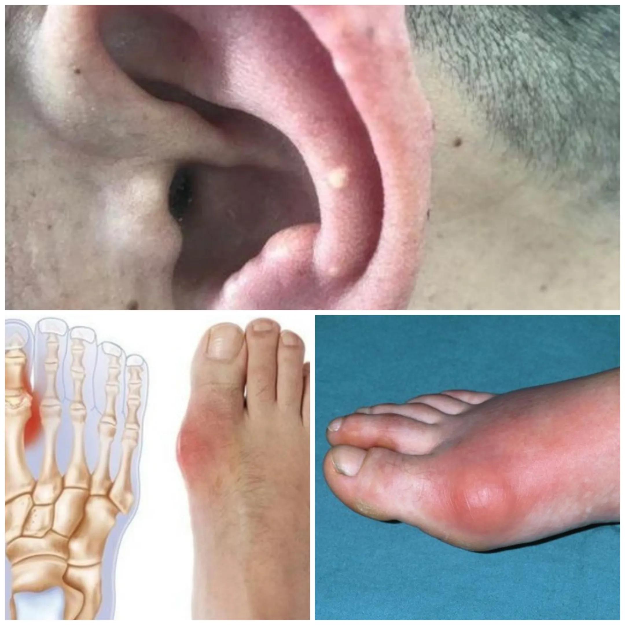 700尿酸属于什么等级,尿酸700多怎么调理