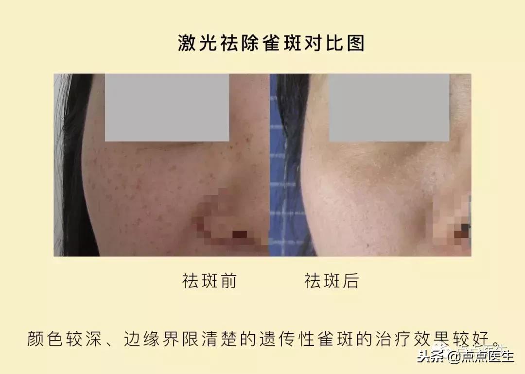 抗衰一定要用医美吗,什么激光抗衰好