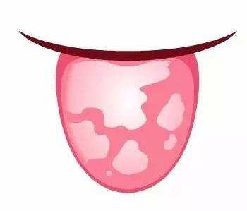 总爱上火是咋回事,儿童地图舌是阴虚火旺吗