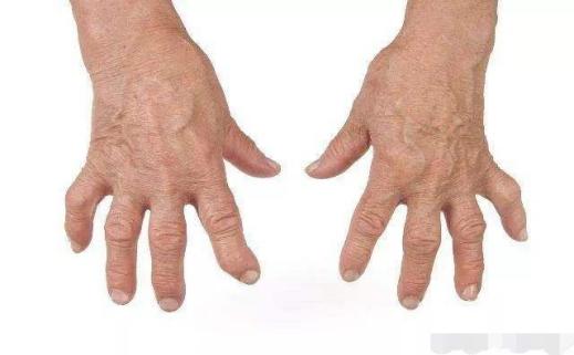 骨关节炎康复治疗方案,骨关节炎康复科普知识宣传