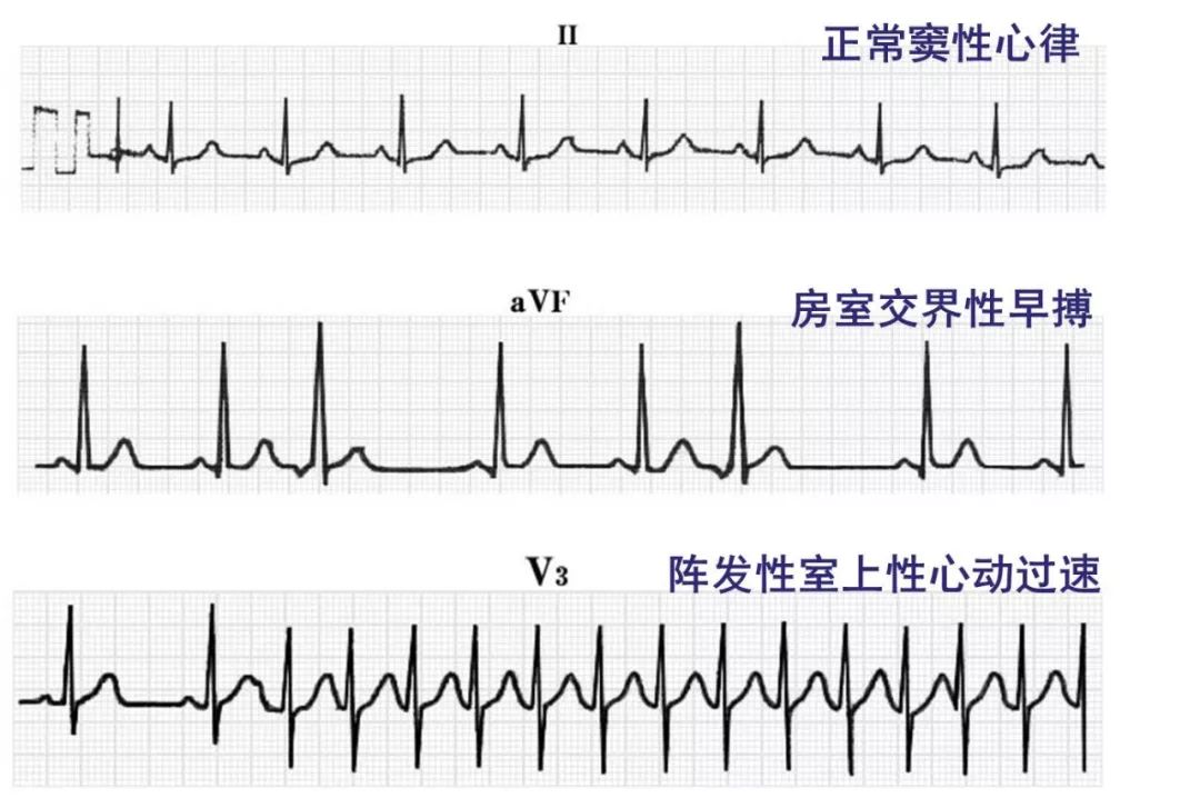 心律失常55分钟讲解,心律失常心电图讲解视频教程全集