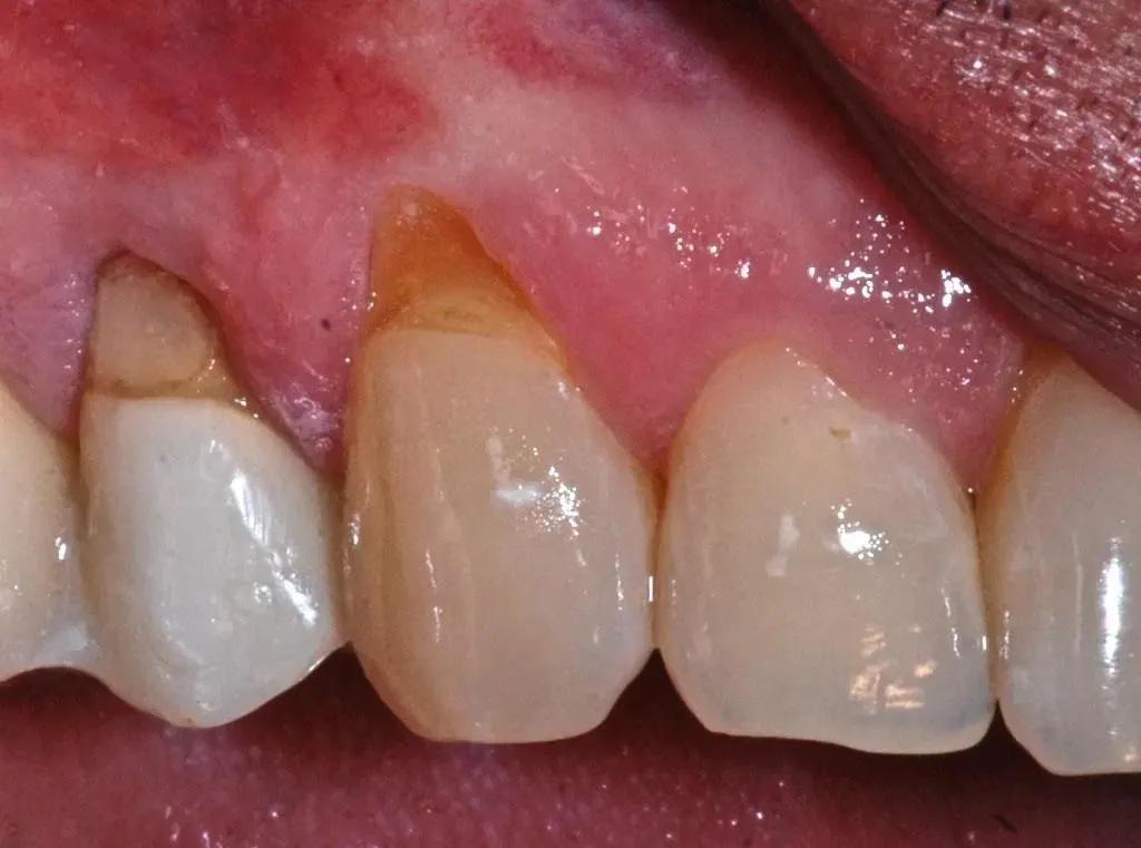 为什么牙龈会萎缩牙齿越来越小,牙龈为何萎缩如何补救